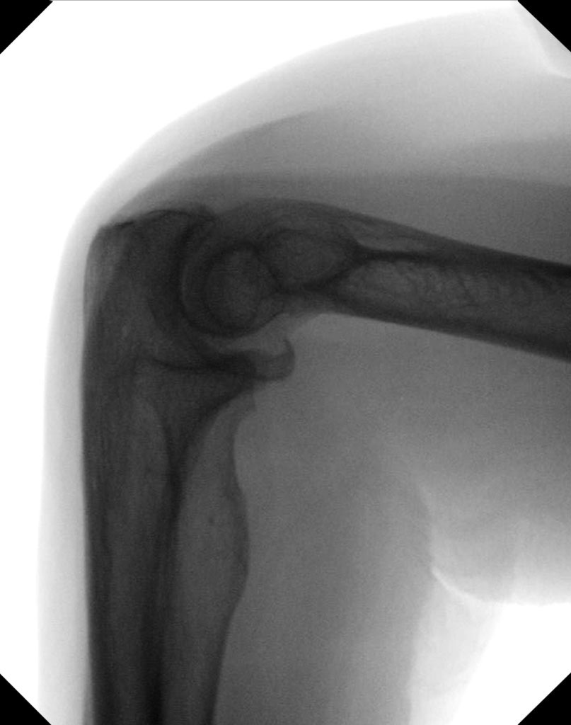 mobile-di-clinical-image-elbow-lateral__web